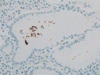Helicobacter pylori (HP)